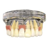 Dental Typodont Model Implant Restoration Tooth Model, Maxillary Implant Study Analysis Demonstration Teeth Model with Removable Teeth and Soft Gum for Study Teaching.
