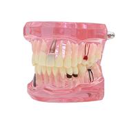 Dentalmall 1 Pc Dental Implant Study Analysis Demonstration Teeth Model #2001 with Restoration Pink
