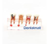 Dentalmall Dental 4-stage Endodontic Treatment Model for Study Teach Teeth Model 4018