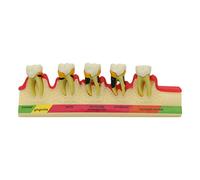 Dentalmall Lab Periodontal Disease Assort Tooth Typodont Teeth Model Study Teach 5-Stage Perio Disease Assort Demo (4010)