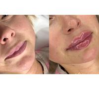 Dermal Filler, 1ml Lips