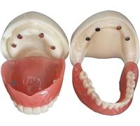Detachable Teeth Denture Anatomical Model, Full Mouth Overdenture with Dental Implant Structure, Teaching Demonstration Model for Adult Dental School