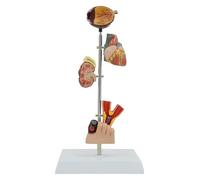 Diabetes Medical Anatomy Model,human Pathology Demonstration Model Teaching Material Cerebral Model,for Doctor's Offices And Classrooms