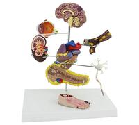 Diabetes Model Heart with Coronary Thrombosis and Arterial Circulation, Educational Display for Blood Vessels, Pancreas, Neurons, and Foot Surgery