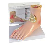 Diabetes Target Model Pain Wind Stone Foot Complication Hypertension Pathological Joint Litholysis