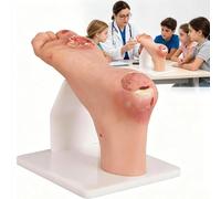 Diabetic Foot Care Model, Diabetic Foot Nursing Simulator Model with Purulent Lesions, Realistic Appearance Design And Highly Simulated, Long-Lasting And Reusable for Nursing School,Severe