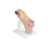 Diabetic Foot Model, Graded Diabetic Foot Simulator with 1-3 Mild or 4-5 Severe Lesions, Purulent Wound Anatomy Model for Wound Care Training and Demonstration-Severe lesions
