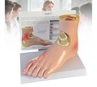 Diabetic Foot Pathology Model for Gout & Hypertension, Life-Size Anatomical Tool for Medical Teaching, Patient Education, Clinic Display