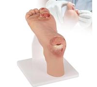 Diabetic Foot Ulcer Model, 1:1 Scale Mild & Severe Pathological Contrast Foot Anatomy, Classification Simulation for Nursing Education & Podiatry Study,Mild