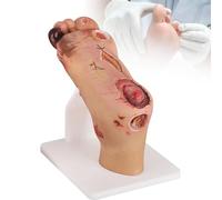 Diabetic Foot Ulcer Model, 1:1 Scale Mild & Severe Pathological Contrast Foot Anatomy, Classification Simulation for Nursing Education & Podiatry Study,Severe
