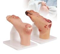Diabetic Foot Ulcer Model, 1:1 Scale Mild & Severe Pathological Contrast Foot Anatomy, Classification Simulation for Nursing Education & Podiatry Study,OneSet