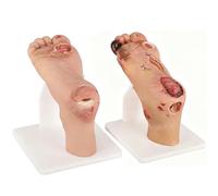 Diabetic Foot Ulcer Model Kit, Two-Stage Simulator for Medical Research Training