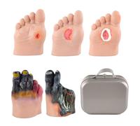 Diatbetic Foot Care Simulators of 5 Stages, Diabetic Foot Ulcer Model Set