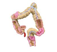 Digestive Pathology Display Aid, Pathological Large i