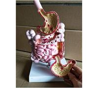 Digestive System Disease Model - Human Organ Anatomical Model Pathological Model of Human Gastrointestinal Tract - Stomach Anatomy Model Teaching Model -Doctor-Patient Communication Model,A