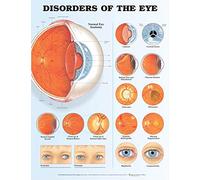 Disorders of the Eye Anatomical Chart