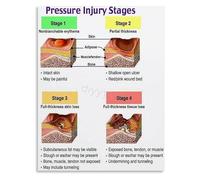 DQFOCPHHAA Wound Care Educational Poster Pressure Ulcer Staging Guide Canvas Painting Wall-Art(Unframed,12x18inch(30x45cm))