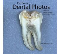 Dr. Ben's Dental Photos: All About Dental Hygiene, Cavities and Plaque