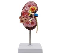 DRXRD Kidney Model Kidney Pathological Model, 3D Kidney Diseases Model with Digital Anatomical Location Identification and Anatomical Position Diagram for Teaching Demonstration and Explanation