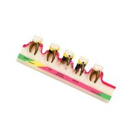 Educational Periodontitis Anatomy Model Realistic Life Size Periodontal Pathology Model Teaching Aid for Demonstration Clinic Patient Education Tool
