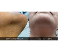 Eight Laser Hair-Removal Sessions on One Medium Area