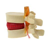 EINCORN Human Anatomy Skeleton Spine Lumbar Disc Herniation Teaching Model Brain Skull Traumatic School Instrume, as the picture shows