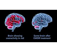 EMDR Training 1 2 3