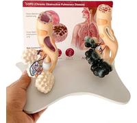 Enlarged Alveolar Structure Model, Smoking Alveoli and Healthy Alveoli Comparison Model with English Back Card, Human Alveolar Anatomical Model for Health Teaching.