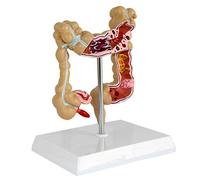 ERNZI Colorectal Lesion Model, Human Colonic Pathological Bowel Disease Model, Medical Anatomy, Teaching Tools