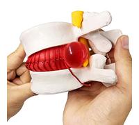 EVOTECH SCIENTIFIC Human Herniated Disc Model, Anatomical Herniated Lumbar Vertebrae Disc Prolapse Model for Medical Teaching Learning Education Display Tool