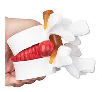 faruijie Anatomical Lumbar Vertebral Model - 1.5X Human Lumbar Disc Herniation Demonstration Model Disc Herniation Model Intervertebral Disc Model