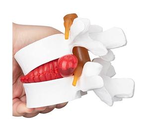 faruijie Anatomical Lumbar Vertebral Model - 1.5X Human Lumbar Disc Herniation Demonstration Model Disc Herniation Model Intervertebral Disc Model