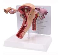 Female Uterus Ovary Model, Pathology Model of Human Female Uterus Ovary Disease Dissection Biology Teaching Aid Anatomy Lesion Uterus