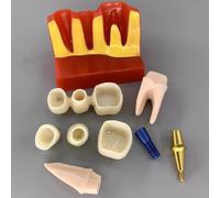 Fituenly Dental Implant Model - 4 Times Removable Analysis Crown Bridge Demonstration Teeth Model Dental Implant Analysis Tooth Model for Learning and Education