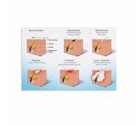 FNYUVNFAF Facial Zones Chart Acne Face Mapping Guide Educational Canvas Print for Bathroom Vanity Skincare Lovers Wall-Art Unframed,08x12inch(20x30cm)