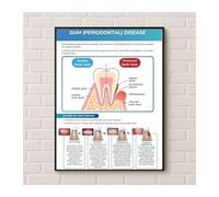 FNYUVNFAF Teeth and Gums Anatomy Poster Periodontal Disease Information Chart Canvas Wall-Art for Student Gift Framed,16x24inch(40x60cm)