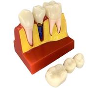 Fopytu 4 Times Removable Analysis Crown Bridge Demonstration Dental Implant Model Teeth Model Dental Implant Analysis Tooth Model for Learning and Education