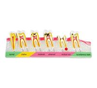 Fopytu Dental Caries Classify Model Demonstration Teach Dentist Teeth Caries Decayed Teeth Analysis Model Dental Teaching Model