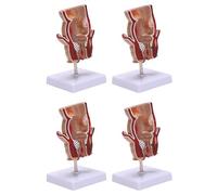 Frewurwer 4X Anatomy Model Human Rectal Lesion Model Fistula Fistula Fissure Pathology Teaching Model