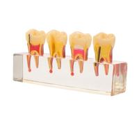 Gadpiparty Model for Education with Resin Primary and Pulp Structure, Realistic Oral Anatomy Teaching Model Supporting Dentist-patient Communication and Caries Progression Visualized,