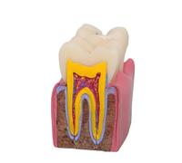 Generic 6 Times Tooth Decay Model, Education Supplies, Teaching Prop, Resin Demonstration Tooth Model for Students Patients Kids