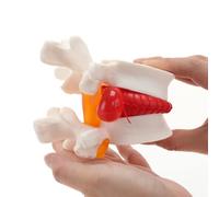 Generic Human Anatomical Lumbar Disc Herniation Model - Lumbar Spine Model for Teaching & Learning (A )