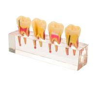 GETAJGHSD Progression Model for Pediatric Oral Pathology Teaching Aid with Resin Material and Interactive Removable Teeth, for Disease Teaching and Clinic Demonstration