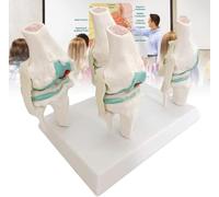 GFLCWYP Human Knee Joint Model Set,Pathology Knee Anatomical Model,Display Knee Degenerative Lesions 4-Stage Normal and Morbid State Osteo-Arthritic