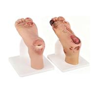 GFLCWYP Teaching Model,Diabetic Foot Ulcer Model Set - Anatomical Accuracy for Mild & Severe Stage Pathology Study-Medical Training Tool for Healthcare Professionals