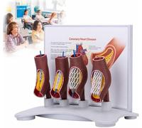 GFLCWYP Vascular Stent Model,Human Coronary Stent Model,Vascular Blockage Model, Vascular Stent Anatomical Model,Human Vessel Enlargement Demonstration Model