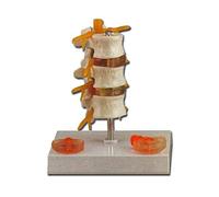 Gima - Anatomical Model of 3 Vertebrae with Hernia and Prolapsed Disc, Highly Detailed, Magnification 1X