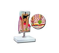 Gima - Anatomical Model of Lower Molar with Caries, Highly Detailed, Magnification 10 X