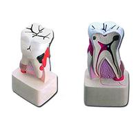 Gima - Anatomical Model of Lower Molar with Dental Pathologies, Highly Detailed, Magnification 4 X