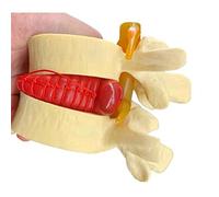 GLJTUO Educational Model Human Lumbar Disc Herniation Demonstration Model, 1:1.5 Lumbar Disc Spine Anatomical Vertebrae Extrusion Demo Model for Medical Demonstration,Medical Models